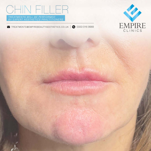 Chin dermal filler injections in Liverpool